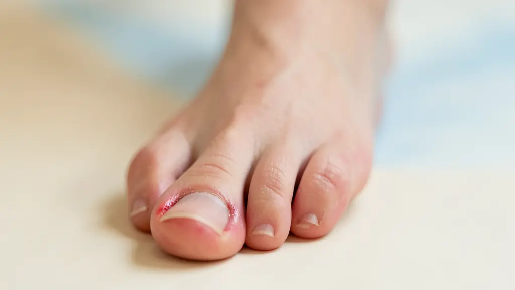 Close-up of a foot with a slightly detached nail capsule, showing slight redness around the cuticle, editorial style, medical context